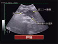 最新腹部疾患超音波診断のコツ=疾患編=
