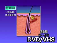 第3巻　脱毛のレーザー治療